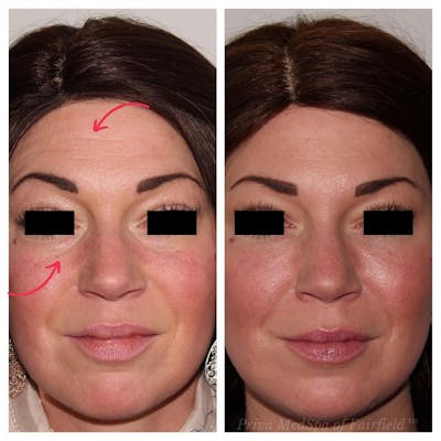 Full Face Rejuvenation Before & After Gallery - Patient 24987554 - Image 2