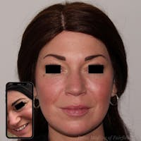 Full Face Rejuvenation Before & After Gallery - Patient 24987554 - Image 1