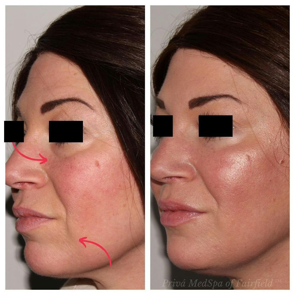 Full Face Rejuvenation Before & After Gallery - Patient 24987554 - Image 3