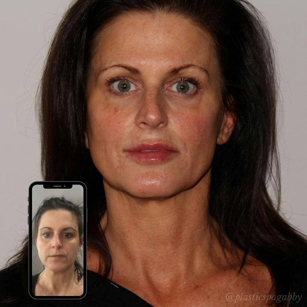 Full Face Rejuvenation Before & After Gallery - Patient 24987350 - Image 1