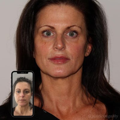 Full Face Rejuvenation Before & After Gallery - Patient 24987350 - Image 1