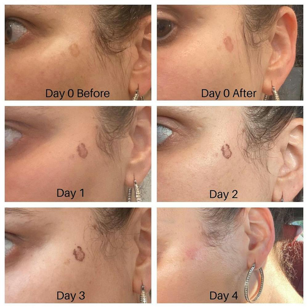 IPL Spot Treatment Before & After Gallery - Patient 24987603 - Image 1