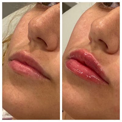 Lip Augmentation Before & After Gallery - Patient 24987614 - Image 2