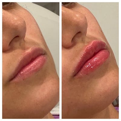 Lip Augmentation Before & After Gallery - Patient 24987614 - Image 1