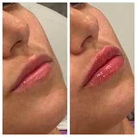 Lip Augmentation Before & After Gallery - Patient 24987614 - Image 1