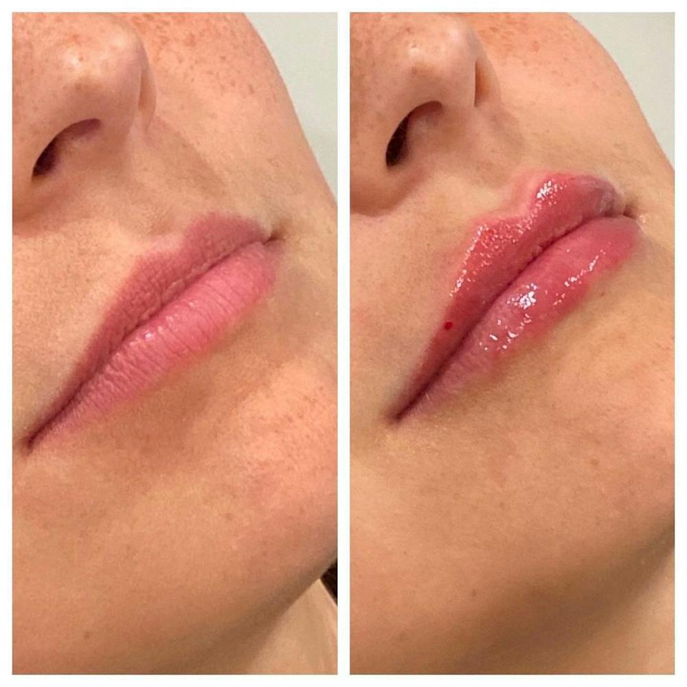 Lip Augmentation Before & After Gallery - Patient 24987627 - Image 1