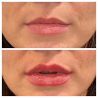 Lip Augmentation Before & After Gallery - Patient 24987644 - Image 1