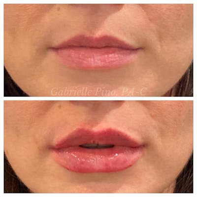 Lip Augmentation Before & After Gallery - Patient 24987644 - Image 1