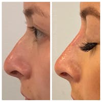 Non-Surgical Rhinoplasty Before & After Gallery - Patient 10910384 - Image 1