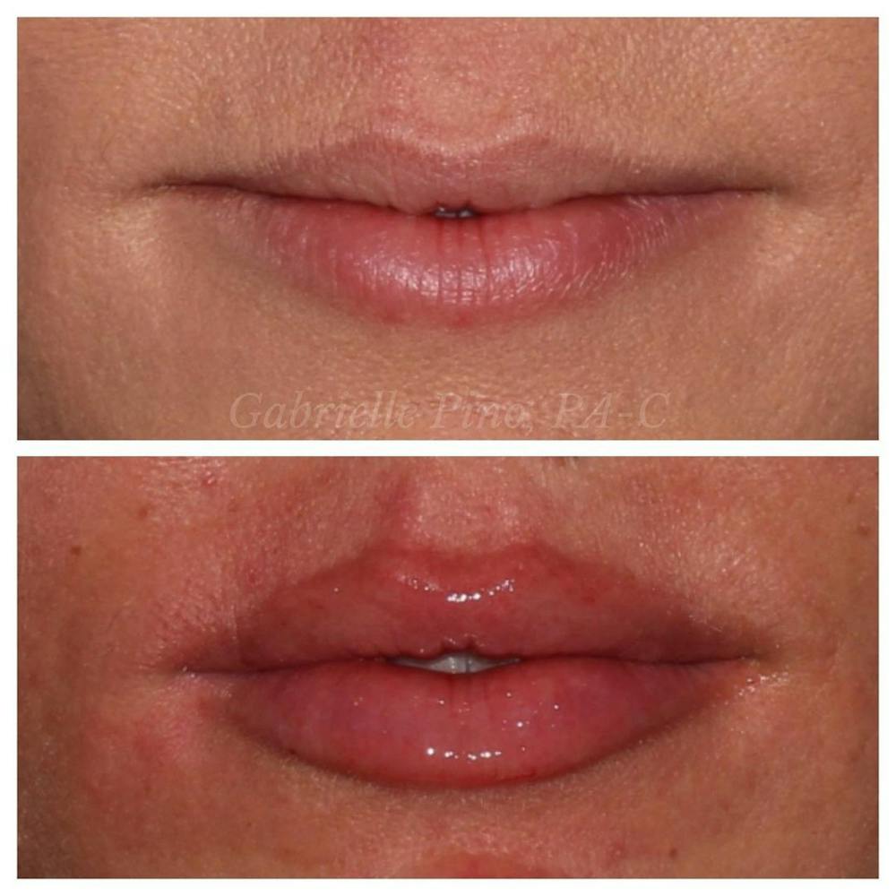 Lip Augmentation Before & After Gallery - Patient 10910408 - Image 1