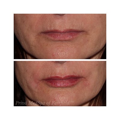 Lip Augmentation Before & After Gallery - Patient 24988722 - Image 1