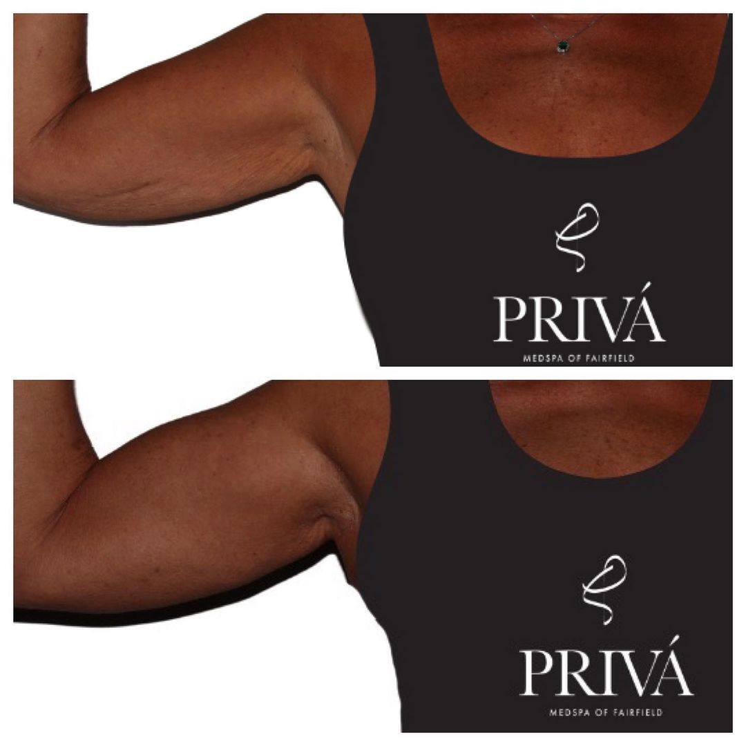 Before and After Evolve Body Contouring in Westport