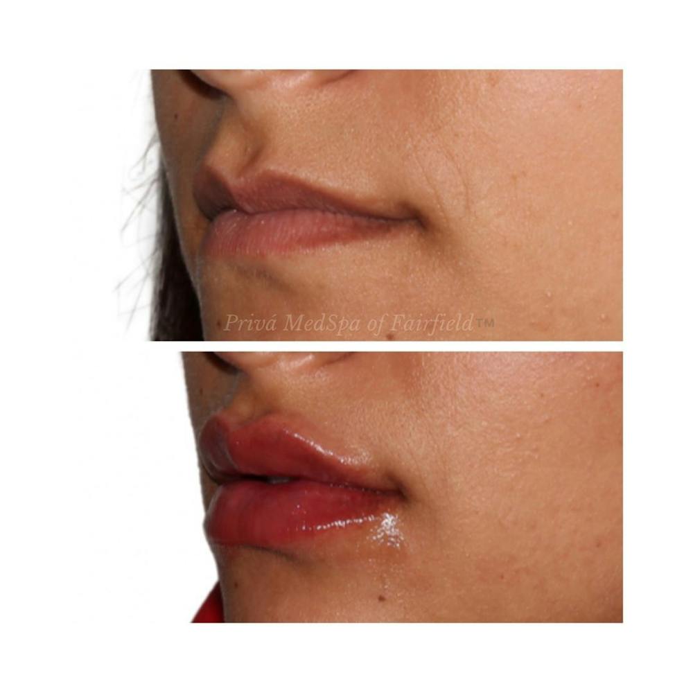 Lip Augmentation Before & After Gallery - Patient 24987459 - Image 2