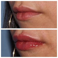 Lip Augmentation Before & After Gallery - Patient 24988600 - Image 1