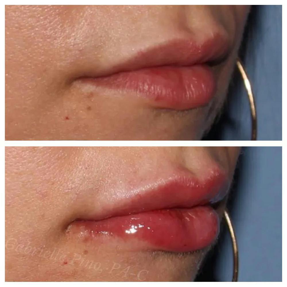 Lip Augmentation Before & After Gallery - Patient 24988600 - Image 2