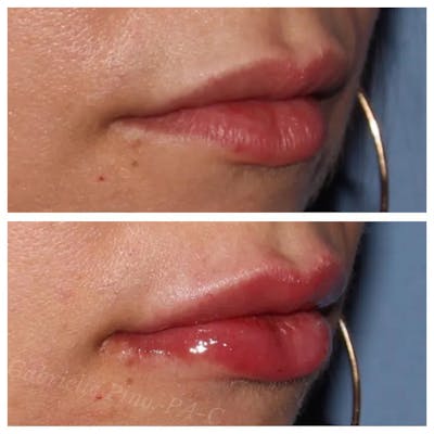 Lip Augmentation Before & After Gallery - Patient 24988600 - Image 2