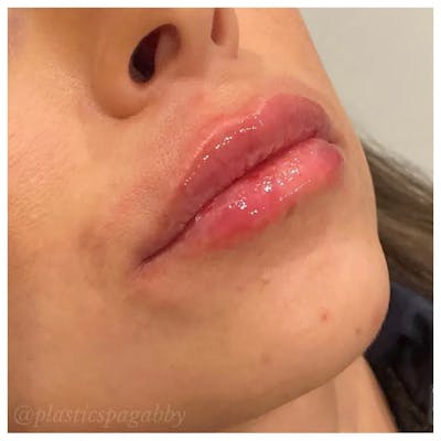 Lip Augmentation Before & After Gallery - Patient 24987708 - Image 1