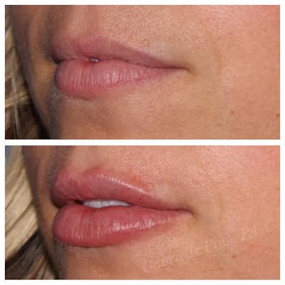 Lip Augmentation Before & After Gallery - Patient 24988450 - Image 1