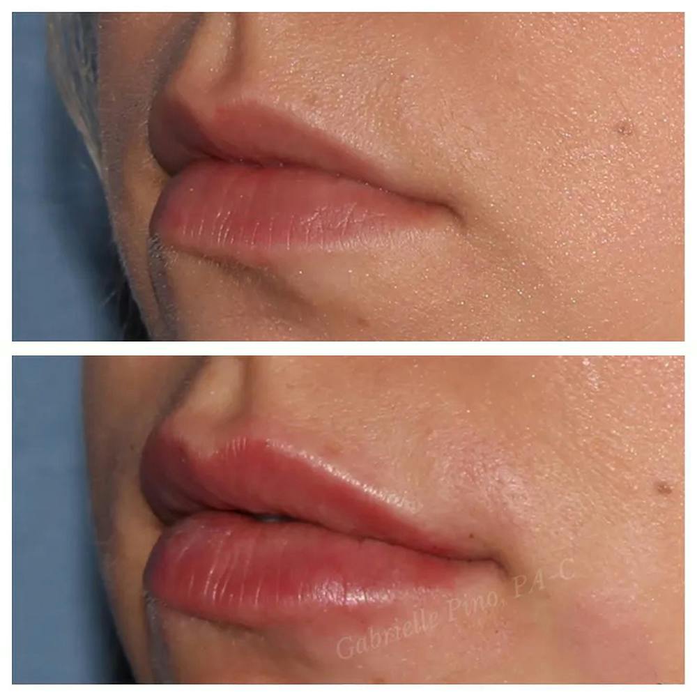 Lip Augmentation Before & After Gallery - Patient 24988717 - Image 1