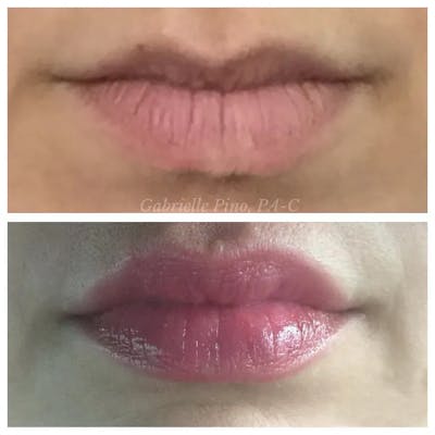 Lip Augmentation Before & After Gallery - Patient 24988721 - Image 1