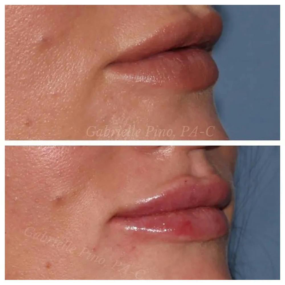 Lip Augmentation Before & After Gallery - Patient 24988632 - Image 1