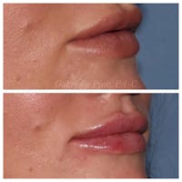 Lip Augmentation Before & After Gallery - Patient 24988632 - Image 1