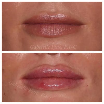 Lip Augmentation Before & After Gallery - Patient 24988632 - Image 2