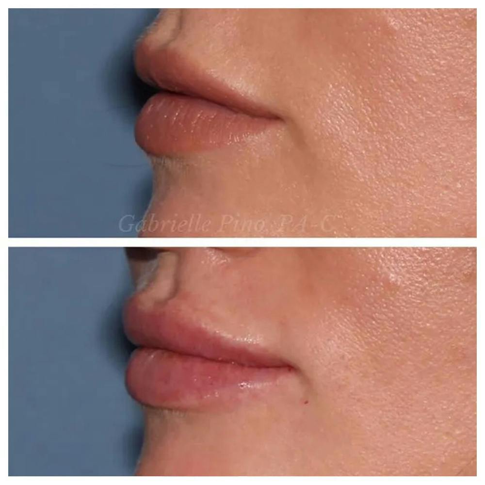 Lip Augmentation Before & After Gallery - Patient 24988632 - Image 3