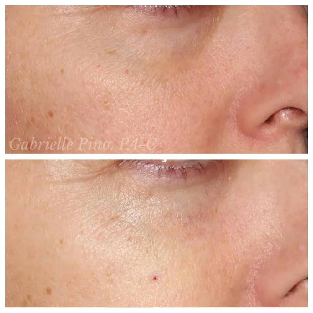 Tear Trough Fillers Before & After Gallery - Patient 24988583 - Image 1