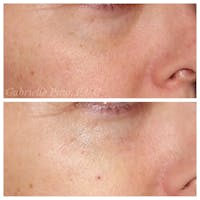 Tear Trough Fillers Gallery - Patient 24988583 - Image 1