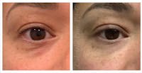 Tear Trough Fillers Before & After Gallery - Patient 24988389 - Image 1