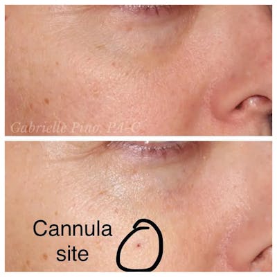 Tear Trough Fillers Before & After Gallery - Patient 24988583 - Image 2