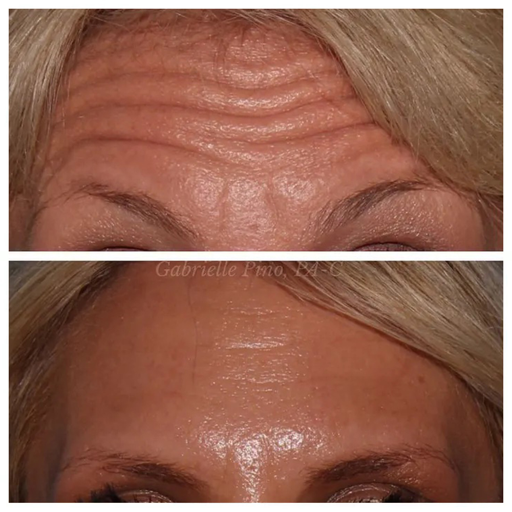 Before and After BOTOX in Westport