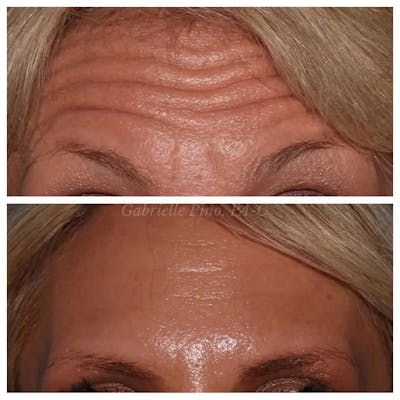 Botox/Dysport/Jeuveau Before & After Gallery - Patient 10910369 - Image 1