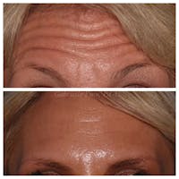 Botox/Dysport/Jeuveau Before & After Gallery - Patient 10910369 - Image 1