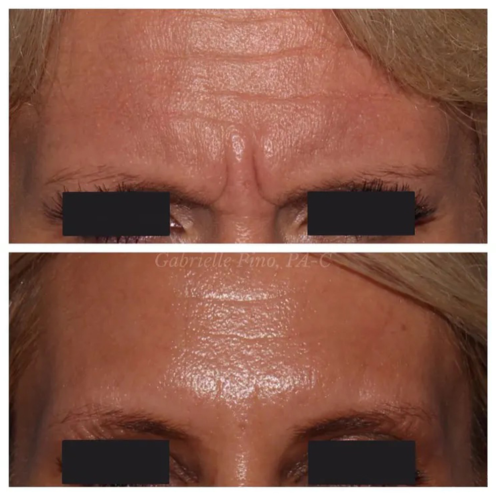 Before and After BOTOX in Westport