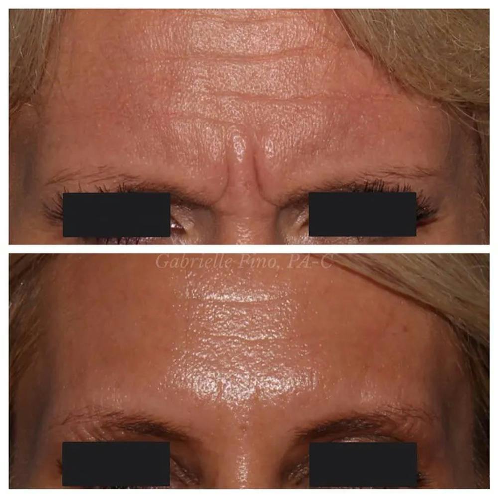 Botox/Dysport/Jeuveau Before & After Gallery - Patient 10910369 - Image 2