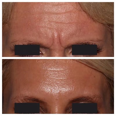 Botox/Dysport/Jeuveau Before & After Gallery - Patient 10910369 - Image 2