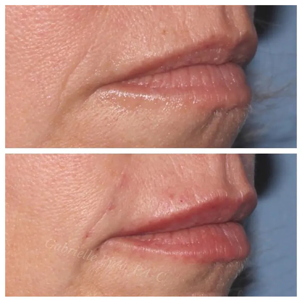 Restylane Before & After procedure