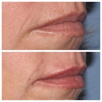 Restylane Before & After Gallery - Patient 24988624 - Image 1