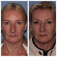 Sculptra Before & After Gallery - Patient 10910390 - Image 1