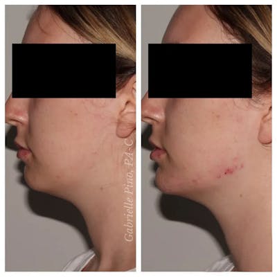 Jawline Contouring  Before & After Gallery - Patient 10910376 - Image 1