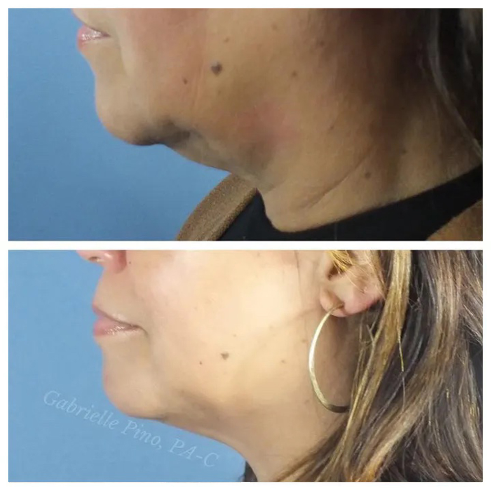 Kybella Before and After Photos