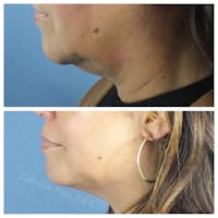 Kybella Before & After Gallery - Patient 10910382 - Image 1