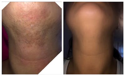Laser Hair Removal Before & After Gallery - Patient 24988424 - Image 1