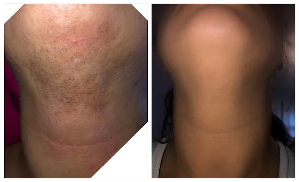 Patient 24988424 | Laser Hair Removal Before & After Photos | Gabrielle  Pino, PA-C