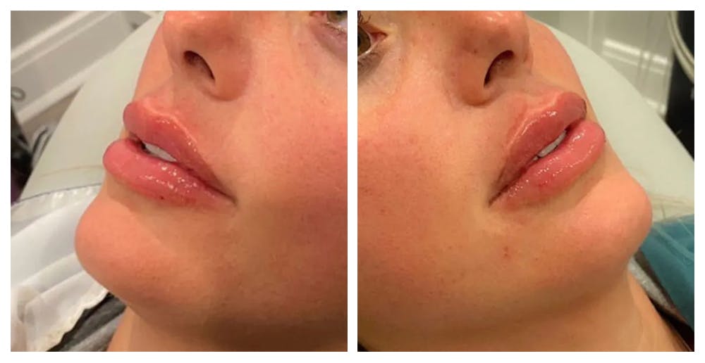 Lip Augmentation Before & After Gallery - Patient 24987682 - Image 1