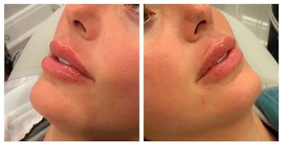 Lip Augmentation Before & After Gallery - Patient 24987682 - Image 1