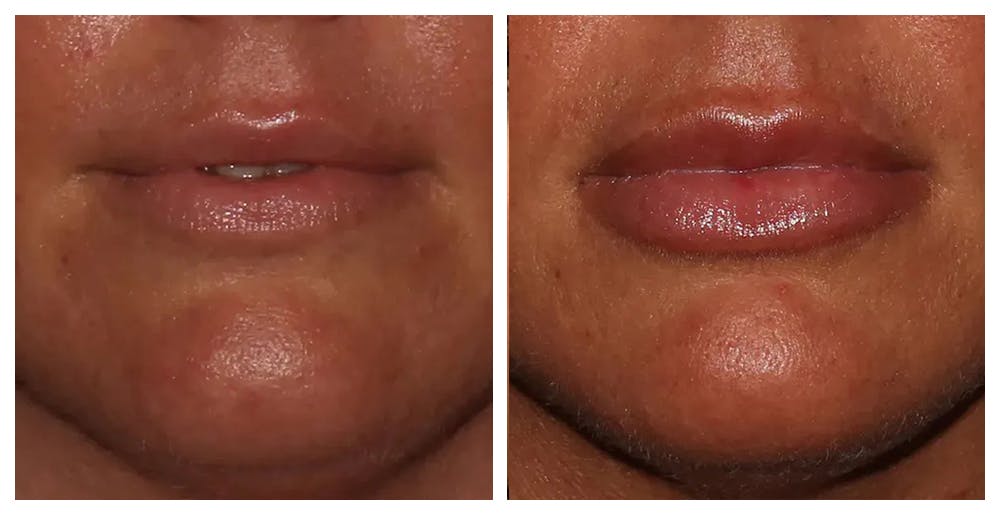 Lip Augmentation Before & After Gallery - Patient 10910409 - Image 1
