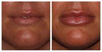 Lip Augmentation Before & After Gallery - Patient 10910409 - Image 1